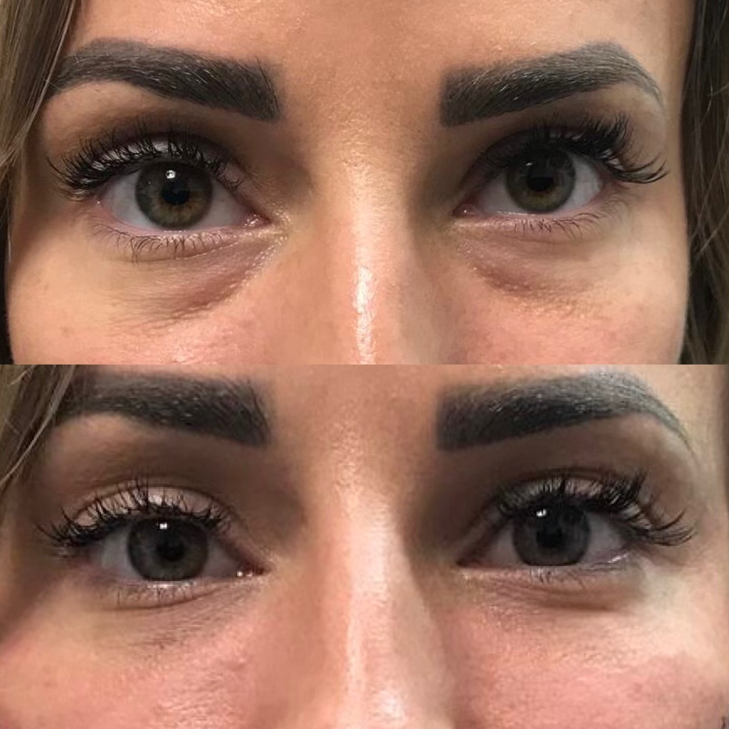 PRF Under Eye Filler Treatment